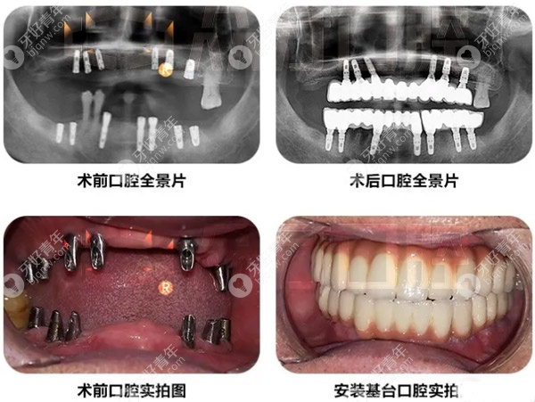 王大爷在众牙口腔做的全口种植的案例